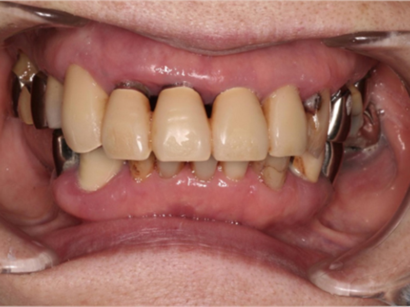 重度歯周病患者様の治療前、治療後ビフォー