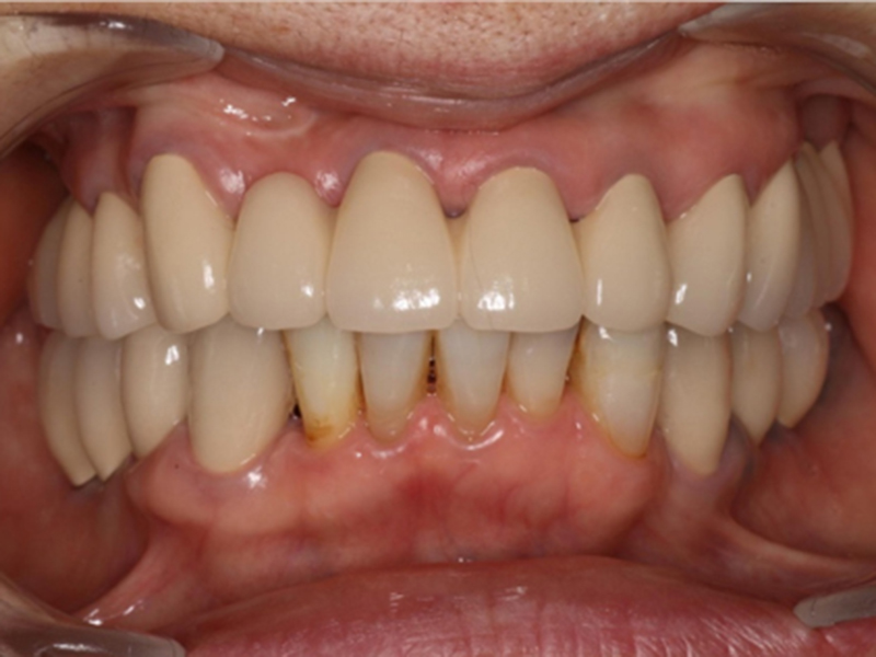 重度歯周病患者様の治療前、治療後アフター